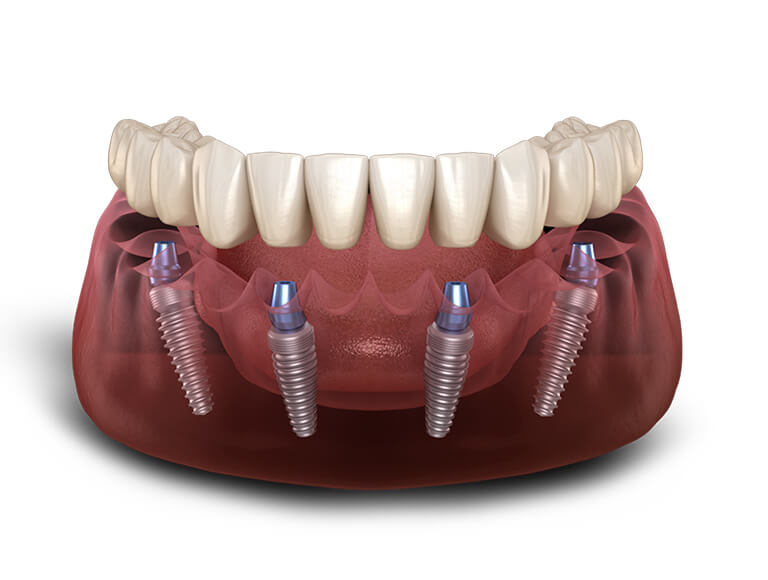 The All-On-4® Technique