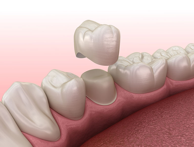 What’s a Dental Crown