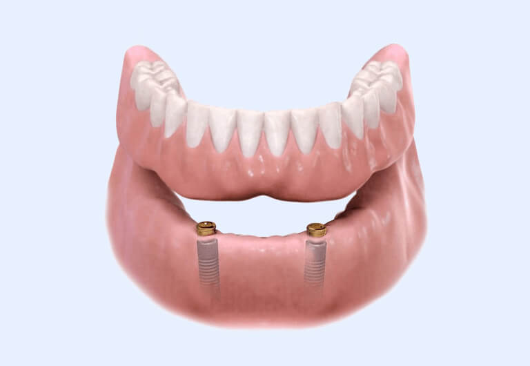 Fixed vs. Removable Implant