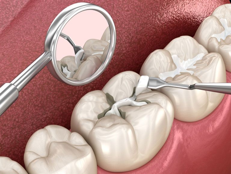 Dental Fillings in King of Prussia, PA