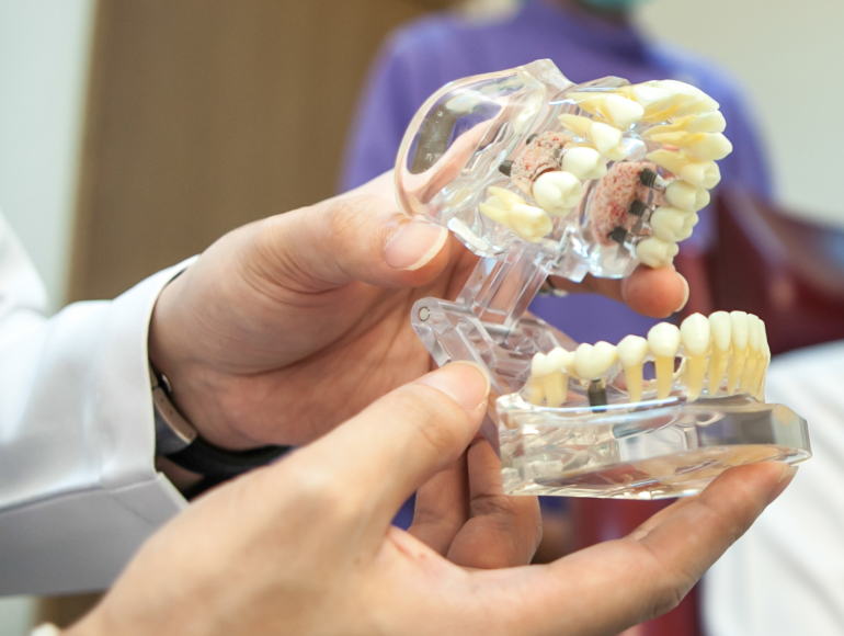 Long-Term Benefits of Dental Implants