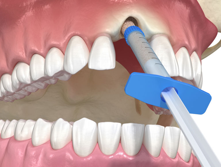 Bone Grafting