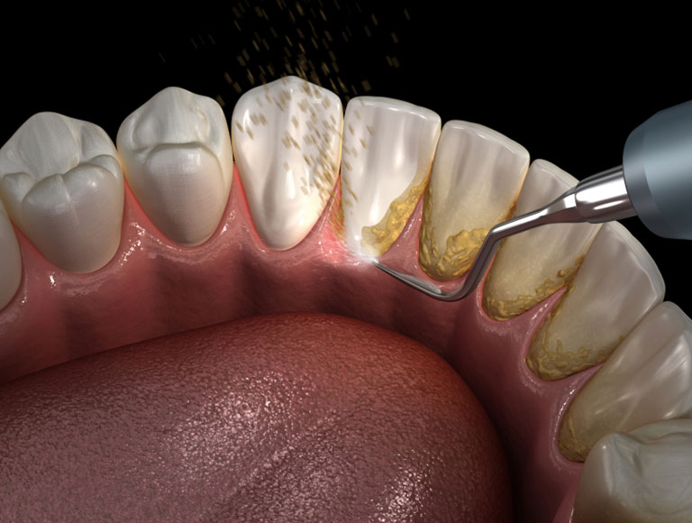 Dental Cleanings & Exams