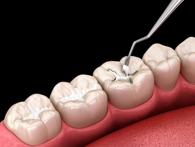 Dental Fillings