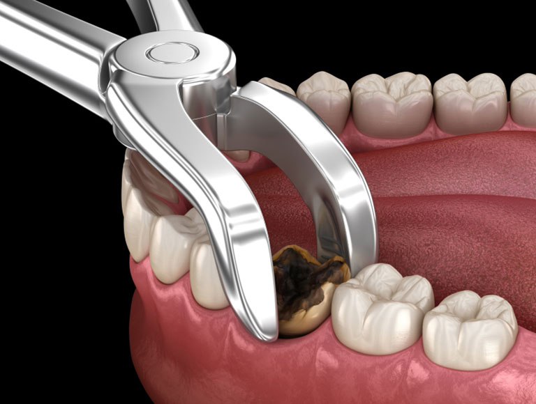 Tooth Extractions